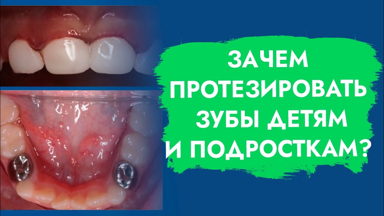 Протезирование зубов у детей. Причины и способы. смотреть онлайн
