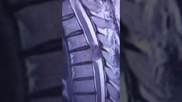 МРТ до удаления опухоли грудного отдела позвоночника (часть 1) смотреть онлайн