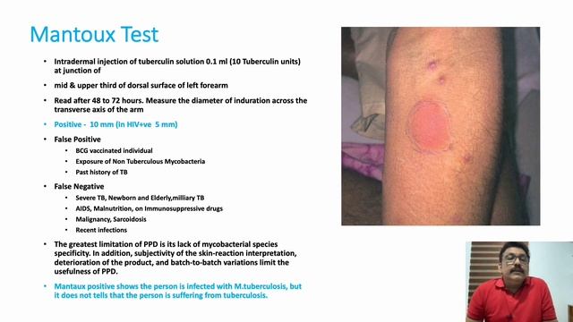 Pulmonary Tuberculosis смотреть онлайн
