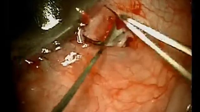 Viscosurgery Assisted EX-PRESS Glaucoma Shunt Implantation