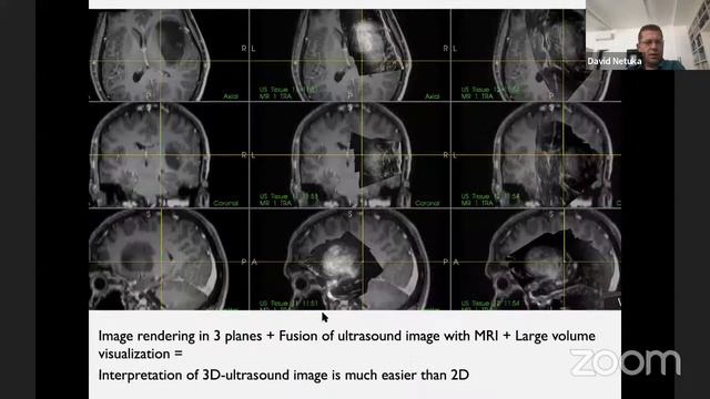 EANS WEBINAR: GLIOMAS смотреть онлайн