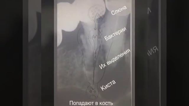 Как кариес приводит к образованию корневой кисты смотреть онлайн