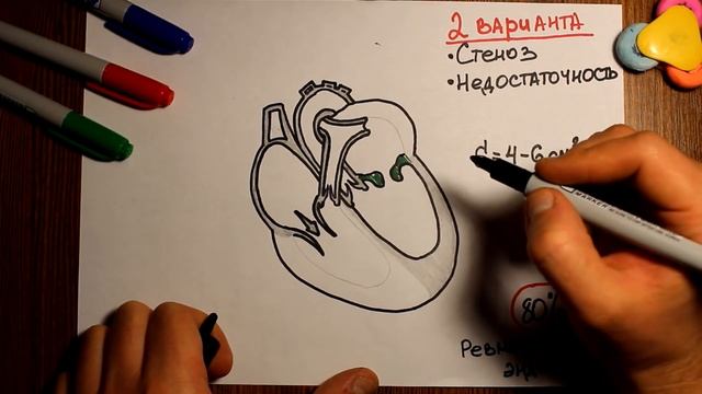 Митральный стеноз. Гемодинамика при пороках сердца. - 