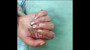 Восстановление сухожилий глубоких сгибателей 3 4-5 пальцев во II зоне