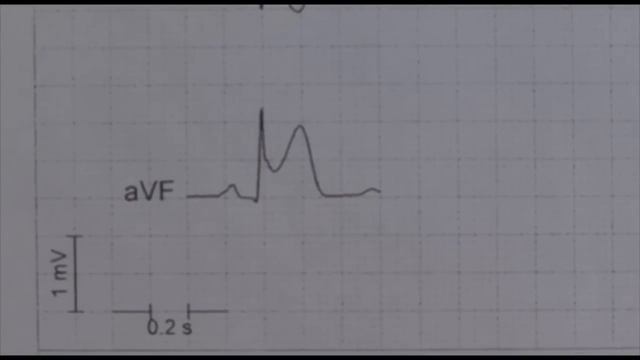 12 Lead EKG (ECG) STEMI examples смотреть онлайн