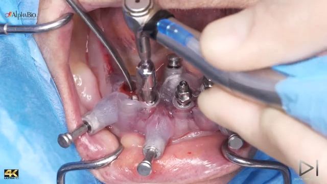 Dr Giampiero Ciabattoni - Immediate Loading Guided Surgery Lower Jaw