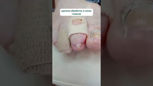 частая проблема 2-го пальца смотреть онлайн