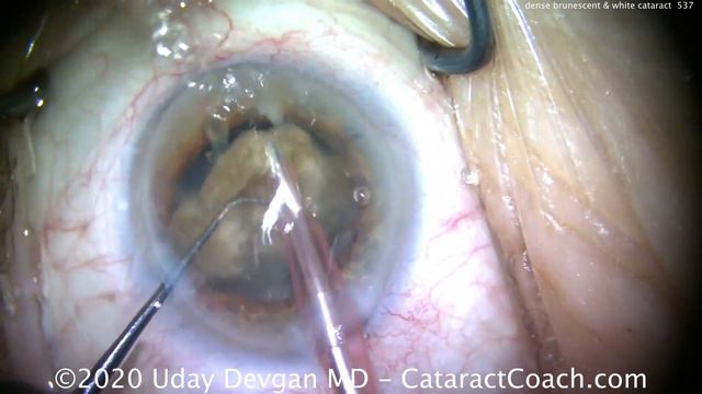 Complete Cataract Case: Dense Brunescent & White Cataract смотреть онлайн
