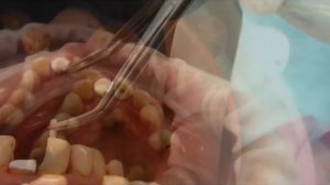 Установка штифта