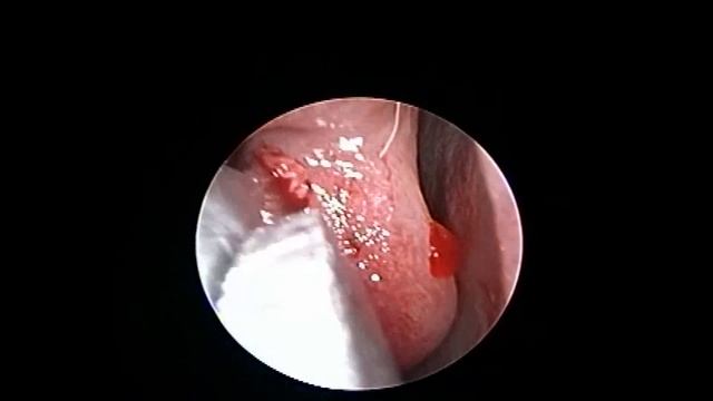 Endoscopic Concha Bullosa Excision Under Local Anesthesia Without Debrider