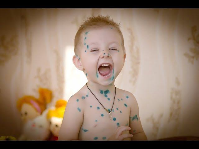 Ветрянка у детей: что необходимо знать родителям смотреть онлайн