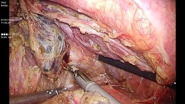 Thoracoscopic Left Pneumonectomy for Lung Cancer: "Node first" technique смотреть онлайн