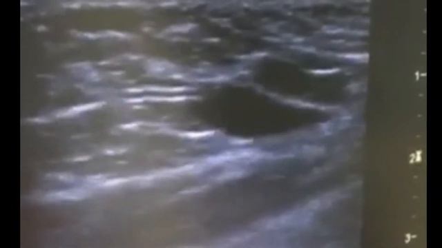 склерозирование лимфатической мальформации смотреть онлайн