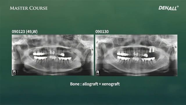 Мастер курс. Хирургия. Лечение инфекции верхнечелюстных пазух смотреть онлайн