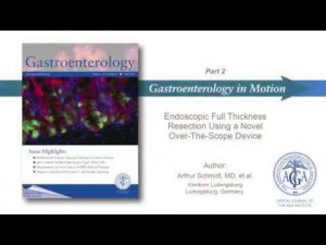 Endoscopic Full Thickness Resection using a Over The Scope Device