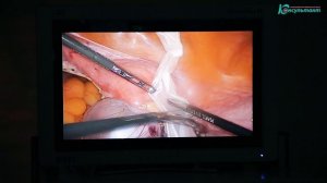 Лапароскопическая аднексэктомия