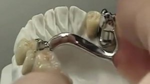 Бюгельный протез   Протезирование бюгельными протезами