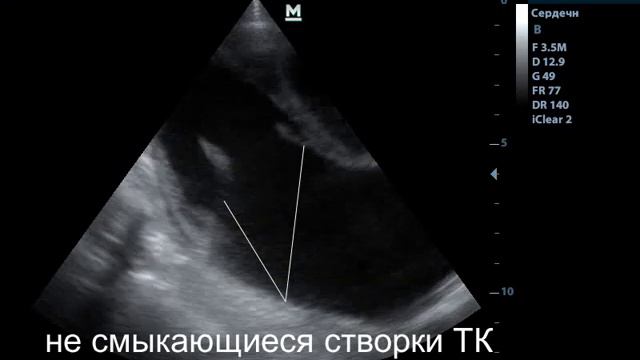 Дисплазия ТК смотреть онлайн