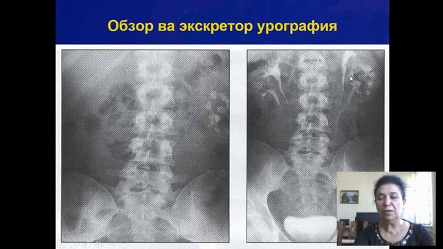 Siydik Tosh Kasalligi