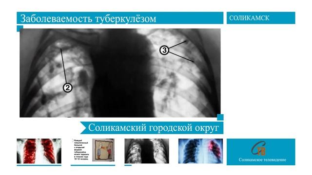 Всемирный день борьбы с туберкулезом смотреть онлайн