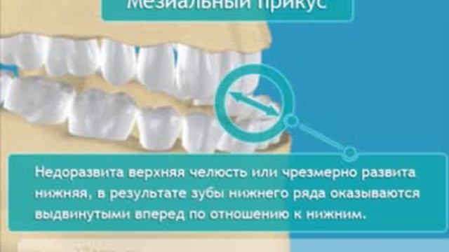 Неправильный прикус зубов