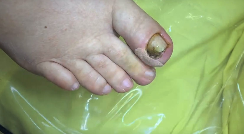 Вросший ноготь ⚠️??? • Воспаление ?? смотреть онлайн