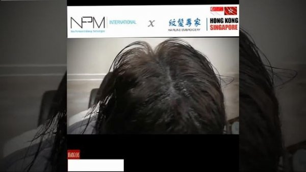 紋髮 紋髮際線 【NPM 紋髮專家】 最多真實紋髮個案 處理過無數個脫髮紋髮的客人 100%滿意 香港及新加坡