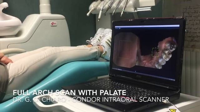 Condor Intraoral Scanner - Full arch scan with palate Dr. G. Di Chiaro смотреть онлайн