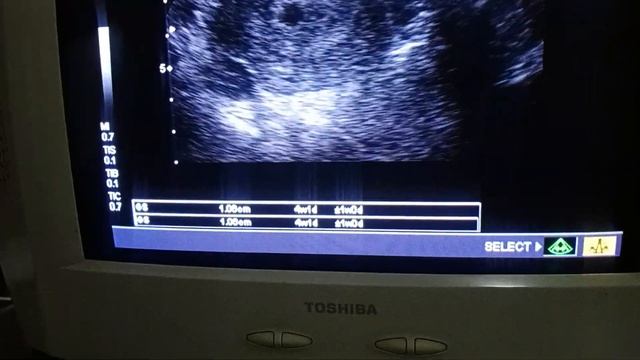 How to find gestational sac with TAS ultrasound at 4 weeks by Dr Fatima смотреть онлайн