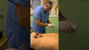 хиджама по китайски безопасно и результативно