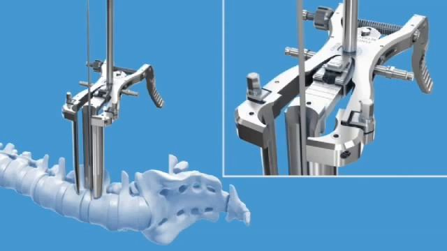 DepuySynthes (Synthes): Oracle Spacer System смотреть онлайн