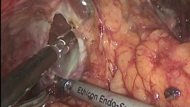 цистпростатэктомия // рак мочевого пузыря // Radical Cystectomy PLND // Mentorship