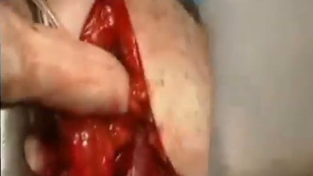 Сетчатый имплант "эргомэш фигурный" смотреть онлайн