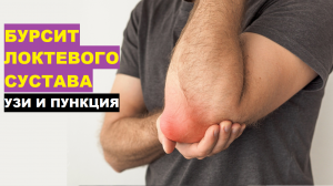 ПУНКЦИЯ локтевого бурсита