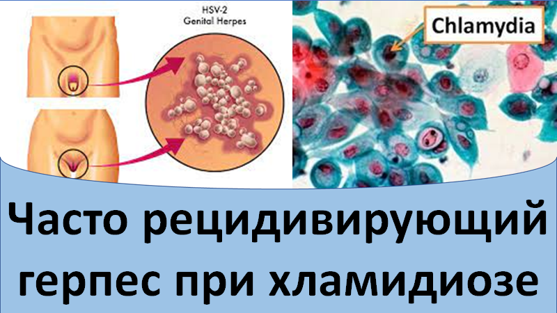 Часто рецидивирующий герпес при хламидиозе смотреть онлайн