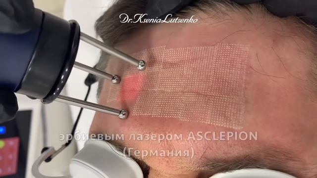 Лазерное омоложение в Краснодаре, косметолог Ксения Луценко 190321 смотреть онлайн