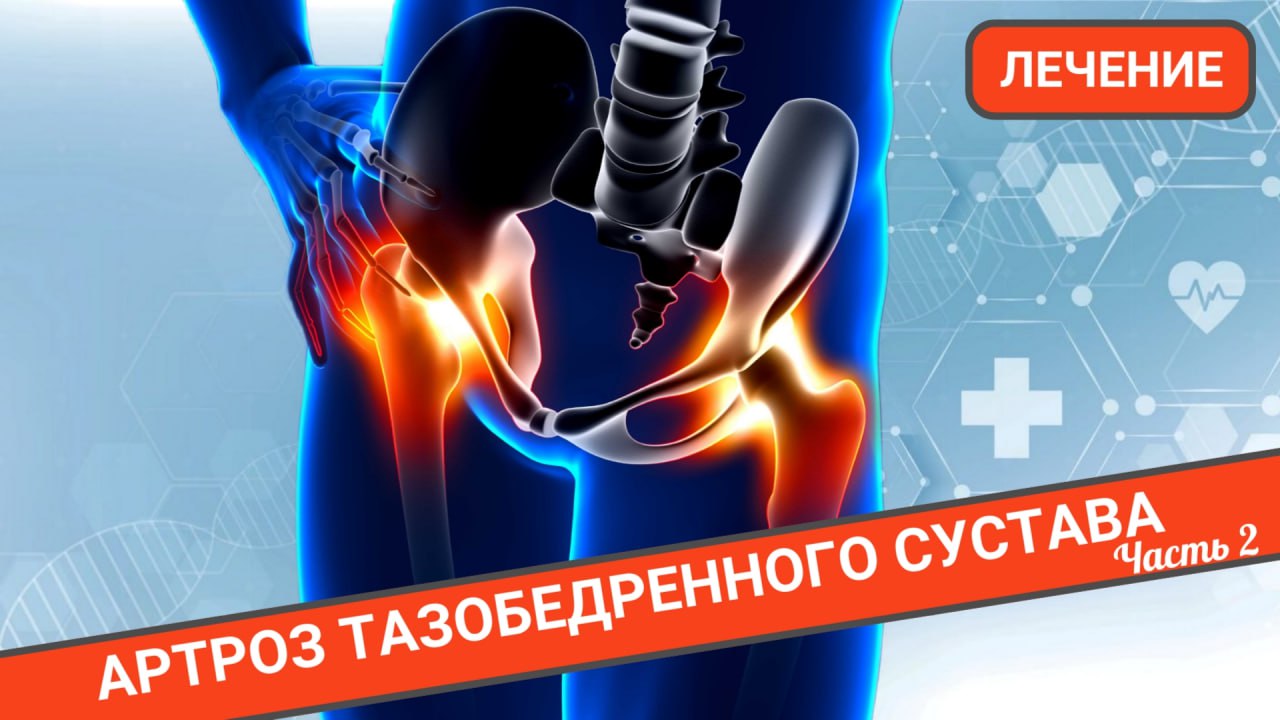 ЛЕЧЕНИЕ ТАЗОБЕДРЕННОГО СУСТАВА (Часть 2) смотреть онлайн