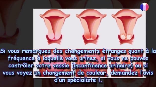 Voici les symptômes du cancer du col de l’utérus, chaque femme doit savoir cela ! смотреть онлайн