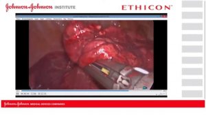 Верхняя лобэктомия справа.