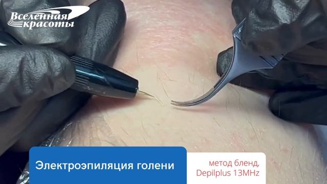 Электроэпиляция голени методом blend смотреть онлайн