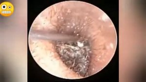 Извлечение ушной серы Слабонервным не смотреть!