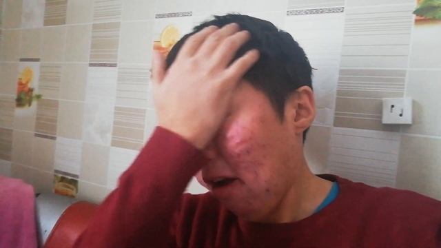 Лечим прыщ , Акне ! Роаккутан ! 25 день ! Диета!Лазерный пиллинг! смотреть онлайн