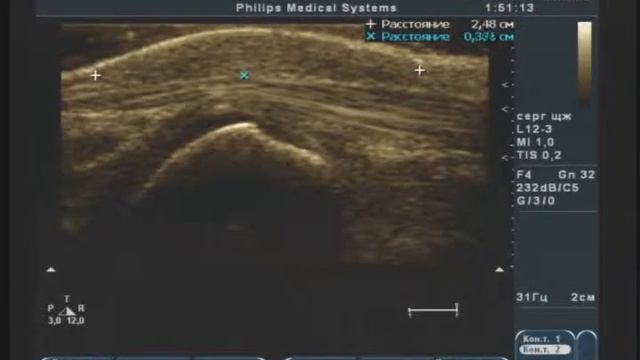 Мозоль тыльной латеральной поверхности стопы смотреть онлайн