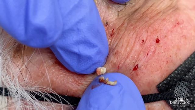 Thankful For... Blackhead Extractions! | CONTOUR DERMATOLOGY