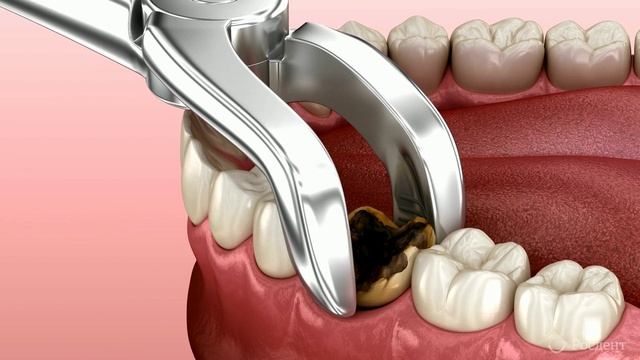 Удаление зуба смотреть онлайн