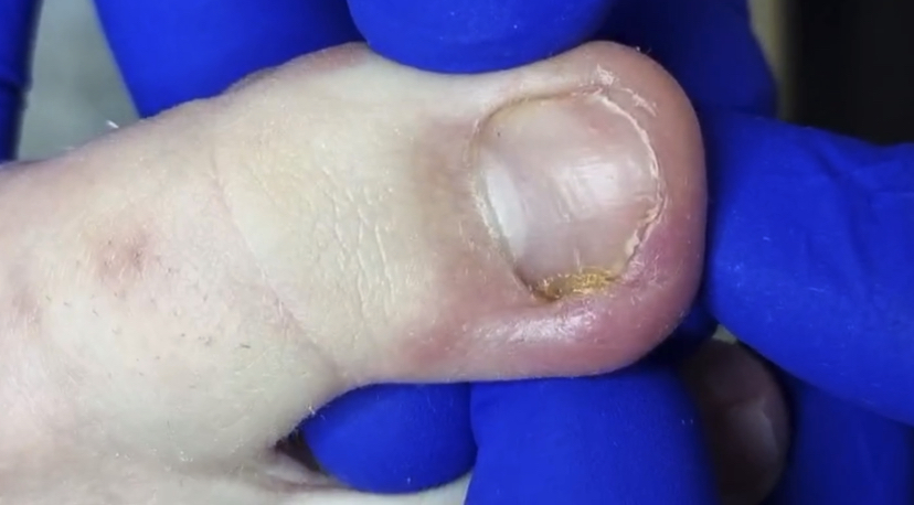 Вросший ноготь + онихолизис ???⚠️?