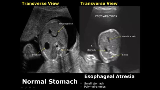 Fetal Stomach Ultrasound Normal Vs Abnormal Image Appearances | Fetal GIT USG Abnormalities смотреть онлайн