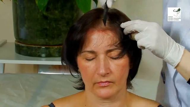 Мезотерапия в трихологии