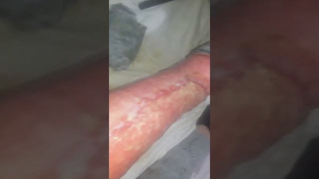 Ожог 3 степени смотреть онлайн