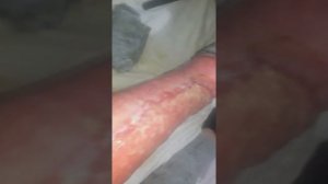 Ожог 3 степени